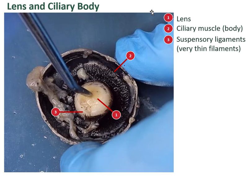 Labeled anterior section of a sheep eye with the lens in place, and a numbered key for the lens, ciliary body, and suspensory ligaments.