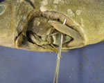 Spleen